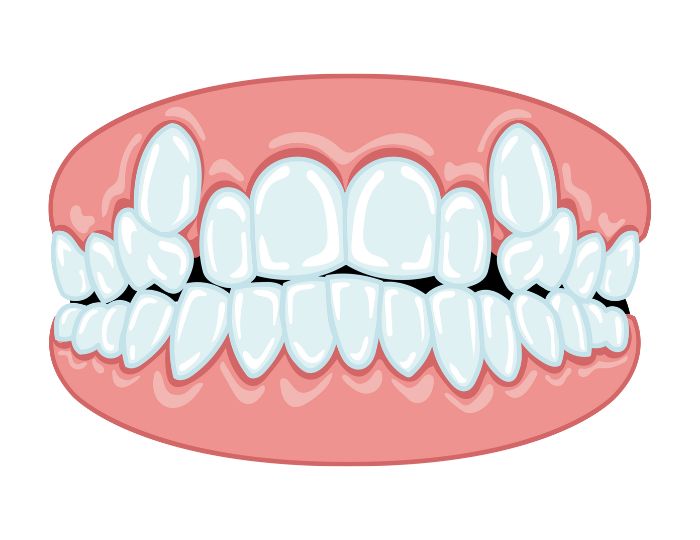 将来の抜歯リスク最小化