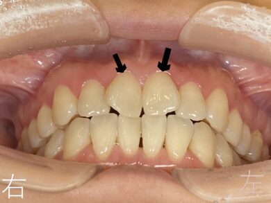 上顎左右前歯部(黒色矢印の歯)のゆがみ【叢生】が確認できます。