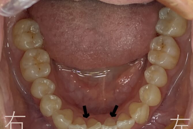 下顎前歯のゆがみ【叢生】が確認できます
