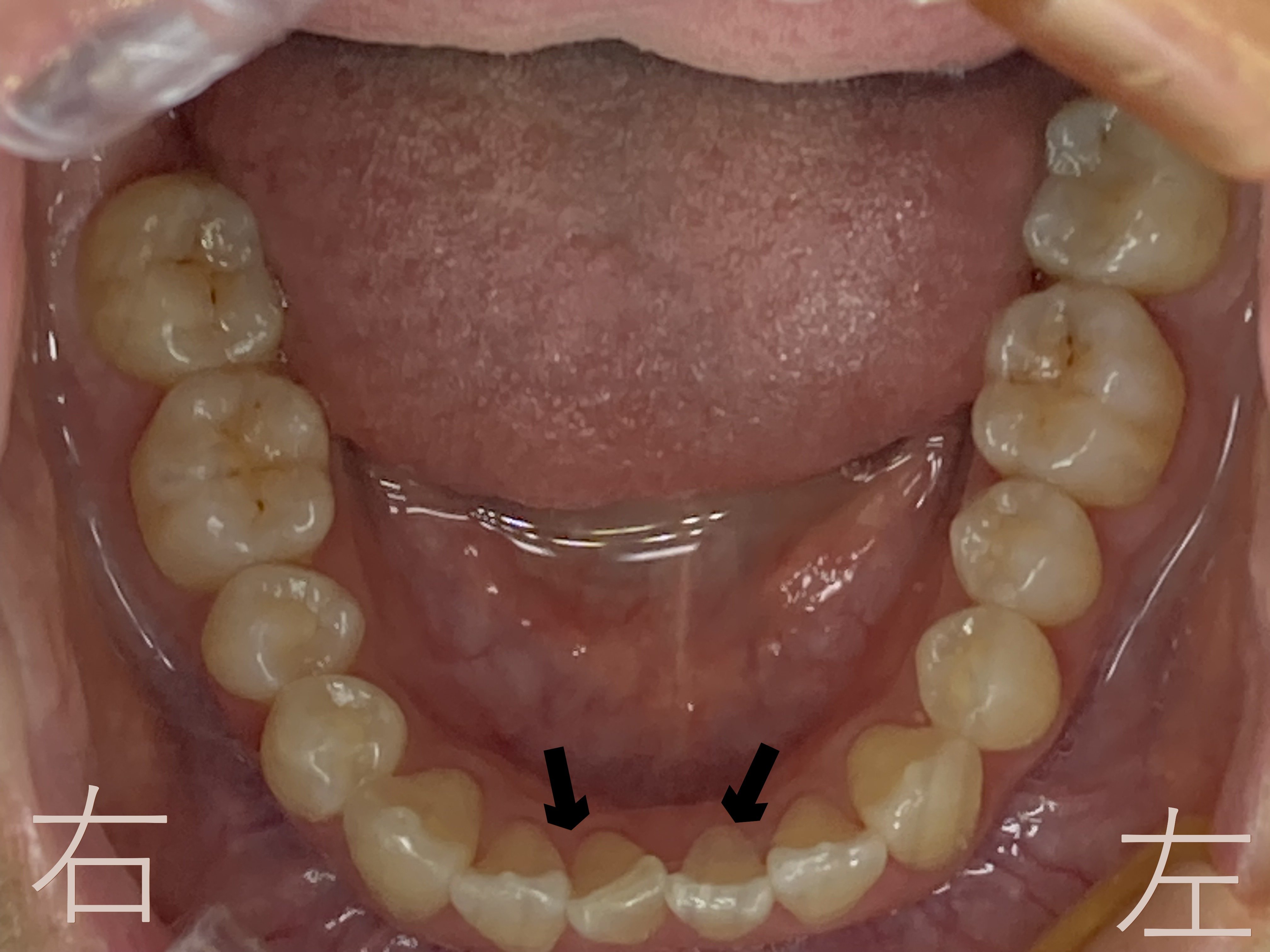下顎前歯のゆがみ【叢生】が確認できます