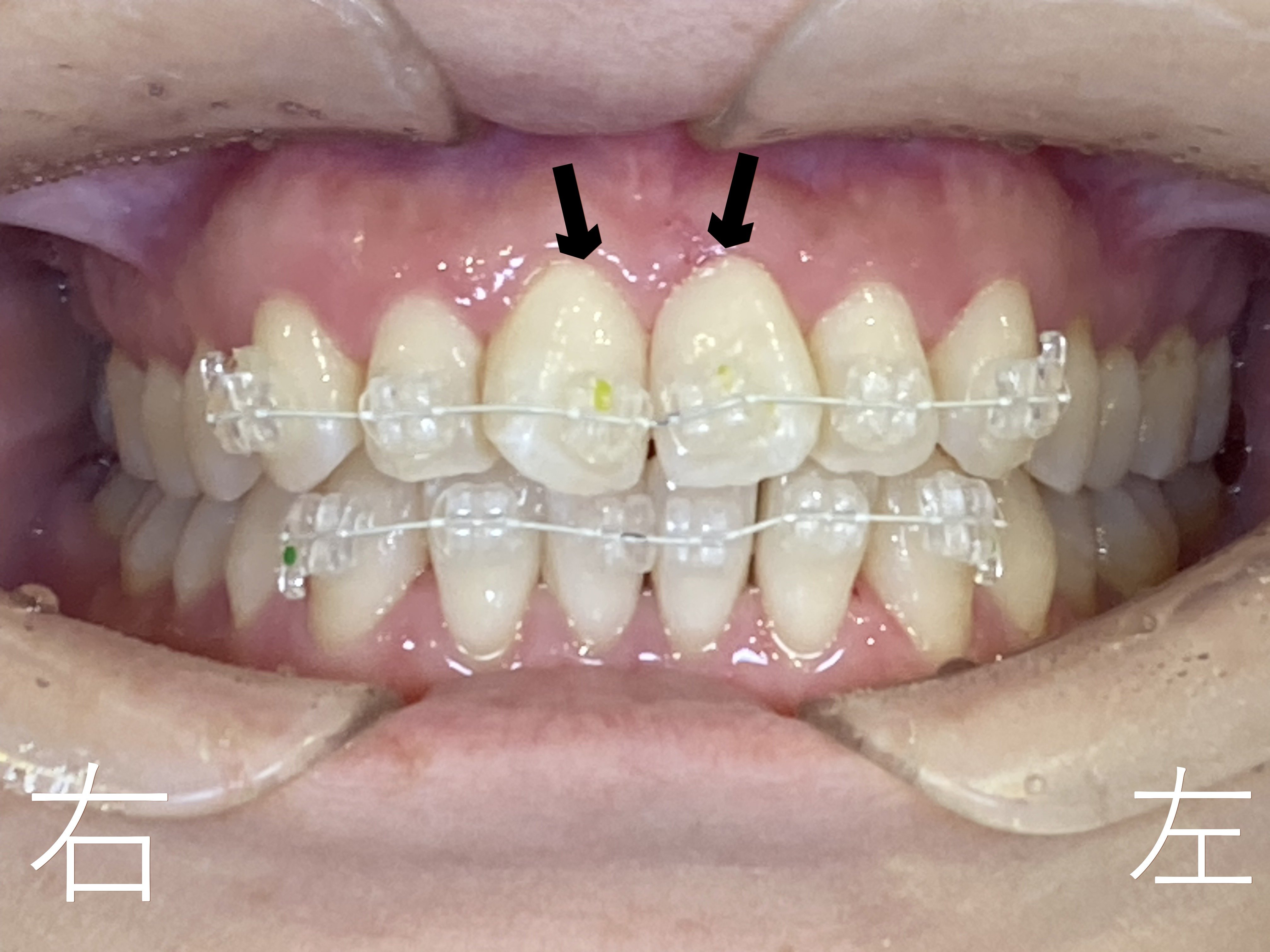 上顎左右前歯部(黒色矢印の歯)のゆがみ【叢生】改善のために上顎前歯にボタン【マルチブラケット】を装着いたしました。