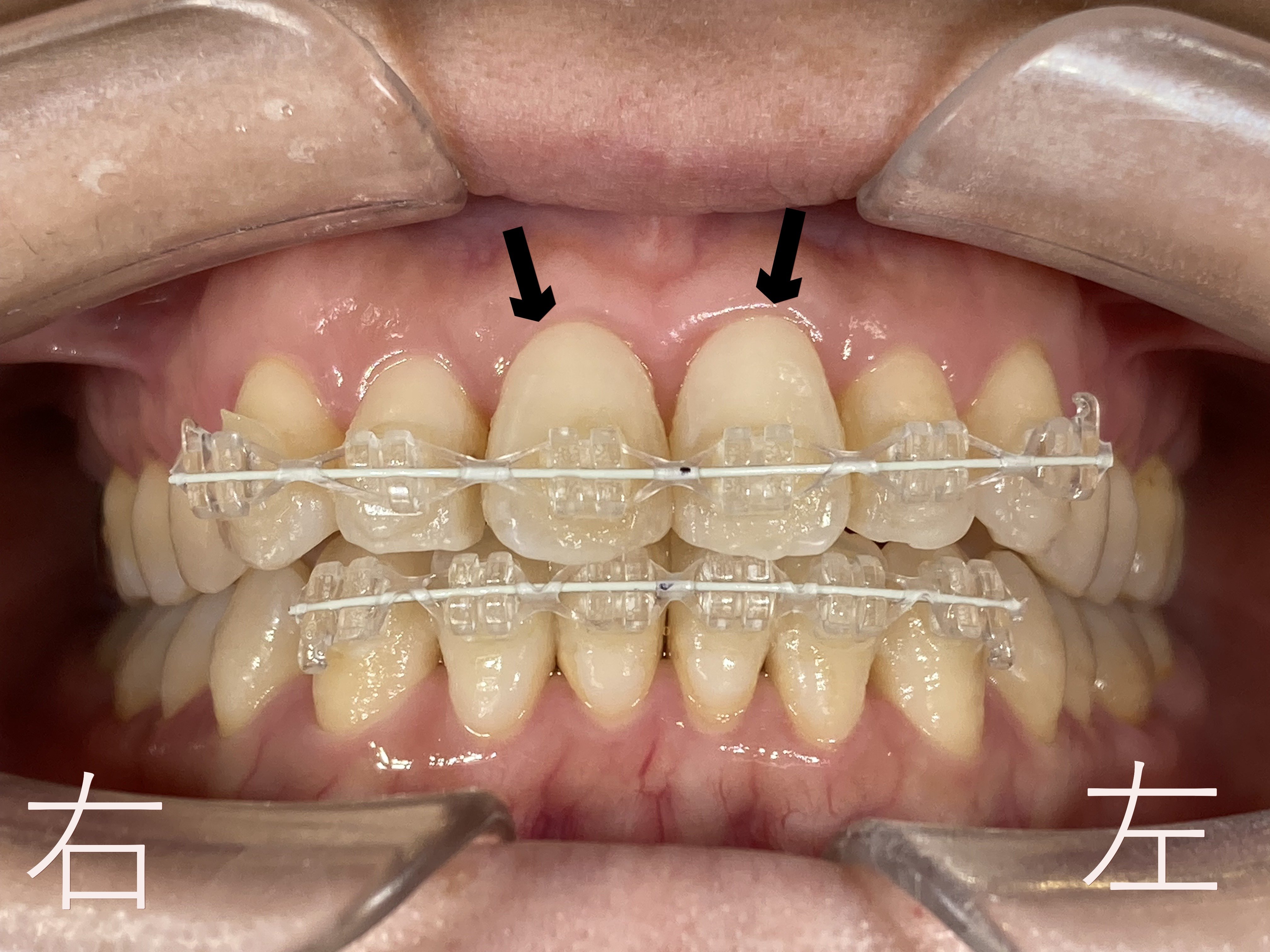 上顎前歯部(黒色矢印の歯)のゆがみ【叢生】が改善したたためボタン【マルチブラケット】を外す前の写真です