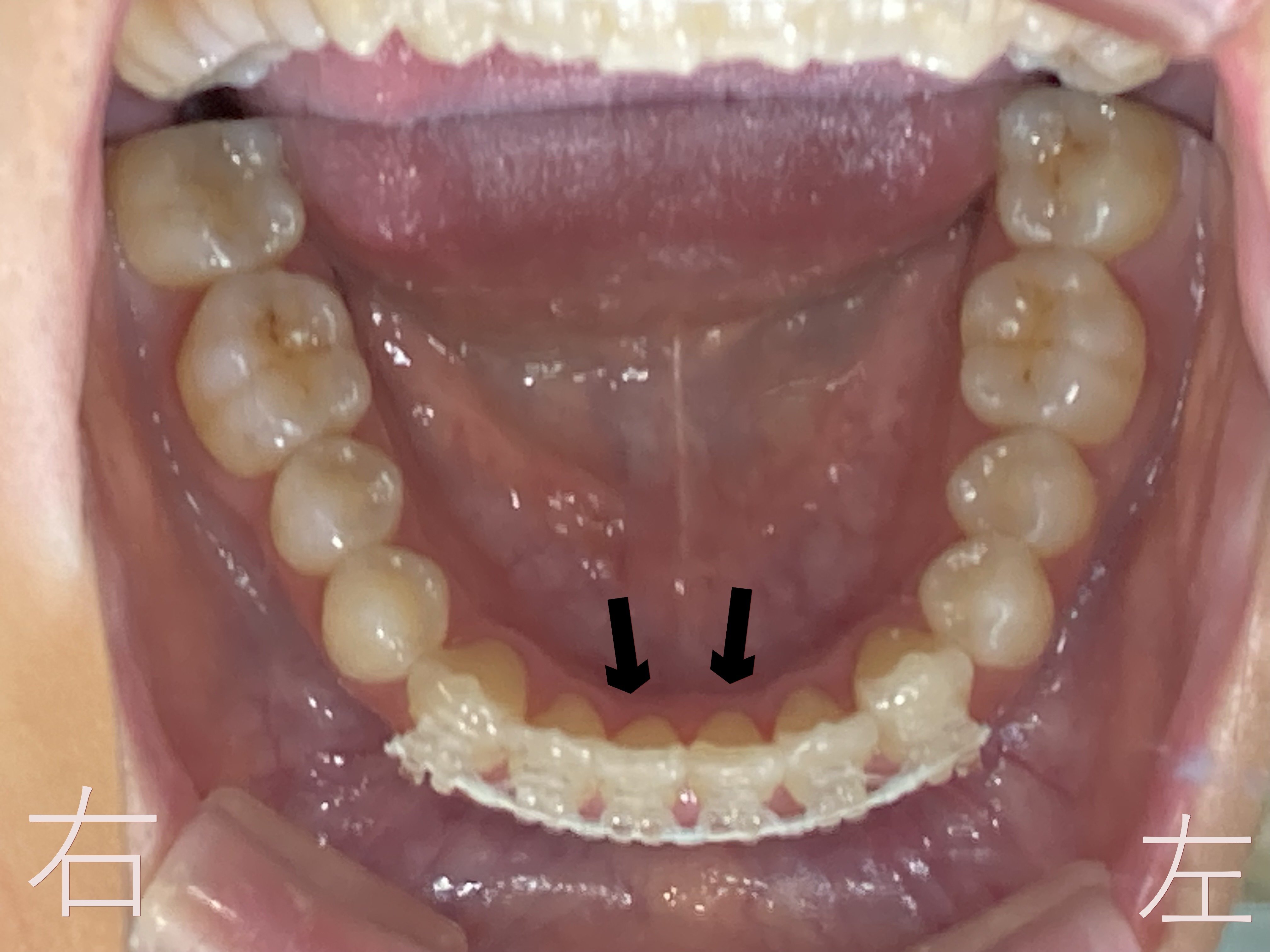下顎前歯(黒色矢印の歯)のゆがみ【叢生】が改善したためボタン【マルチブラケット】を外す前の写真です。