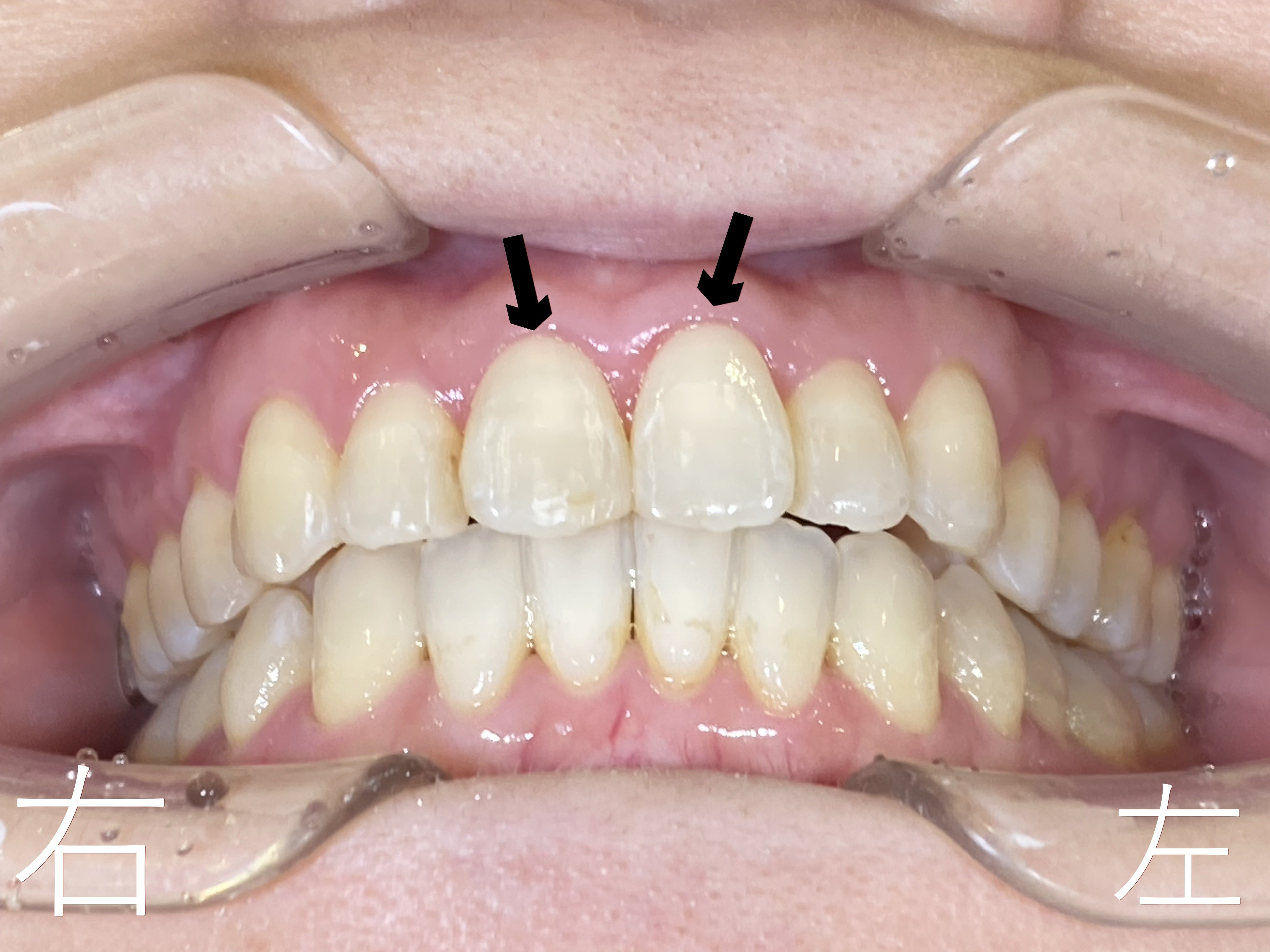 上顎前歯部(黒色矢印の歯)のゆがみ【叢生】が解消したのでボタン【マルチブラケット】を外した後の写真です。