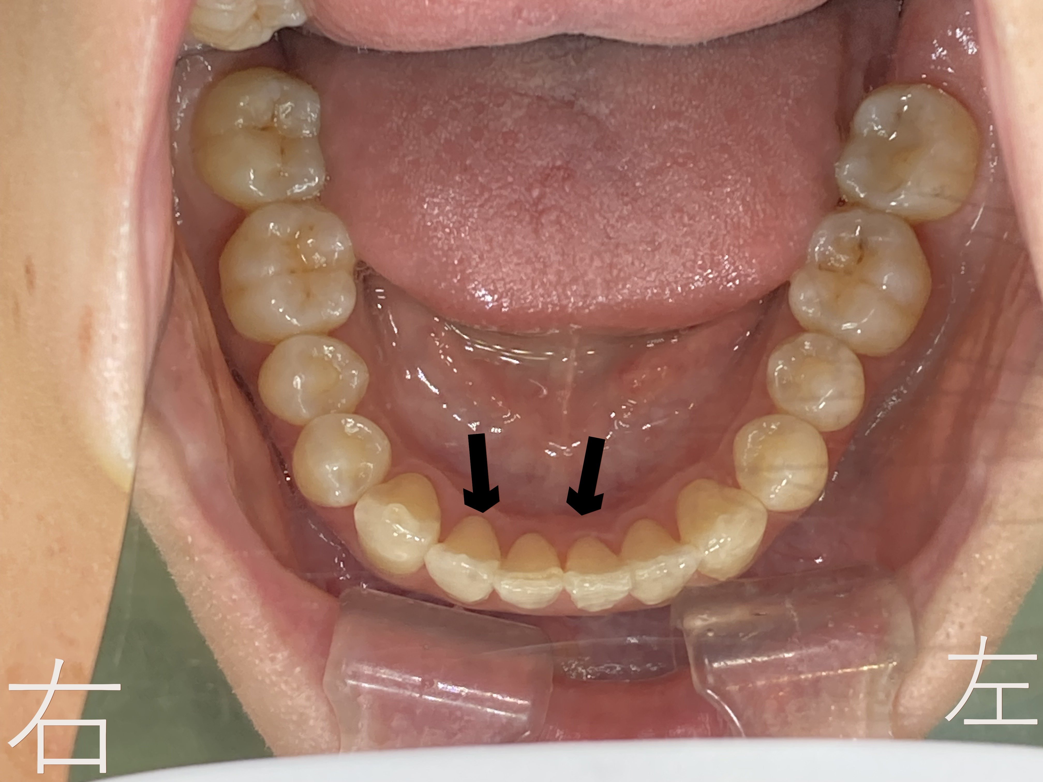 下顎前歯(黒色矢印)のゆがみ【叢生】が改善したのでボタン【マルチブラケット】を外した写真です