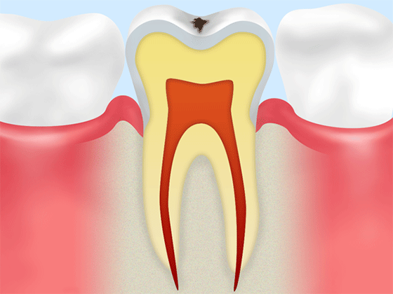 歯の表面が白く濁って見える状態