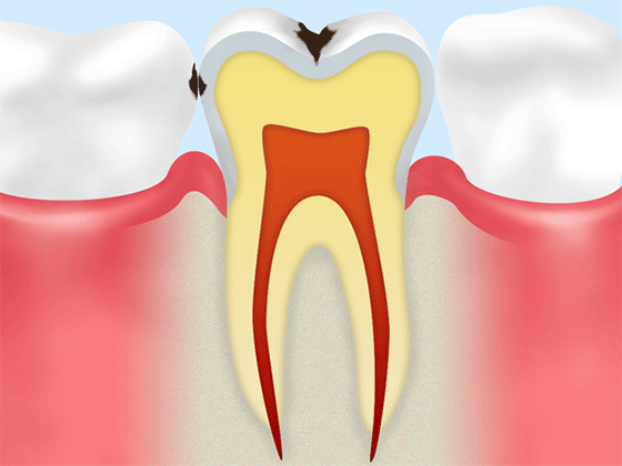 エナメル質だけが溶かされた状態