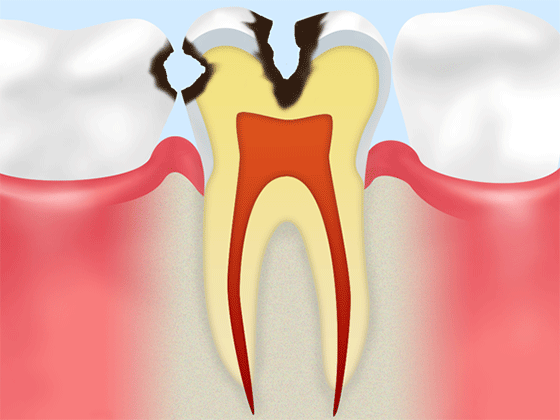 象牙質にまで汚染が進んだ状態