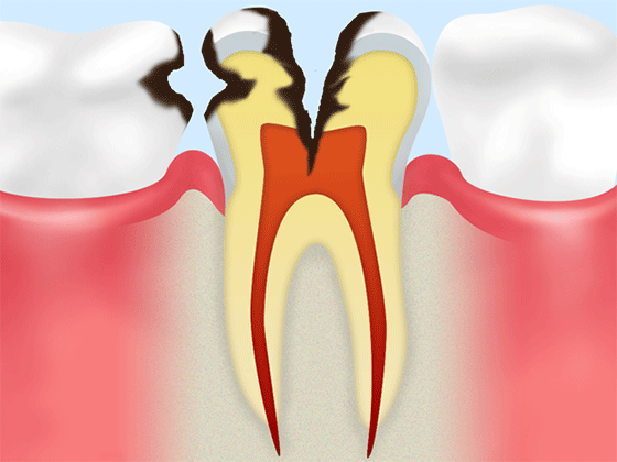 歯の中の神経におよんだ状態
