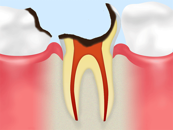 歯質がほとんど残っていない状態