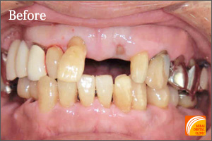 インプラント治療　症例紹介