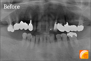 インプラント治療　症例紹介