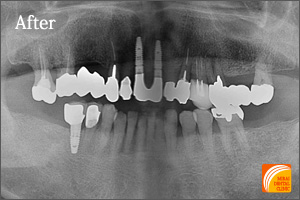 インプラント治療　症例紹介