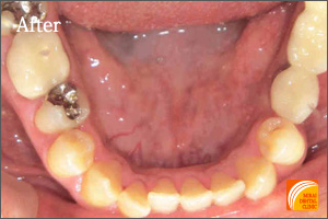 インプラント治療　症例紹介