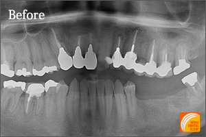 インプラント治療　症例紹介