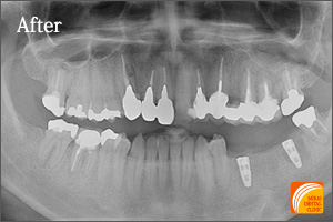インプラント治療　症例紹介