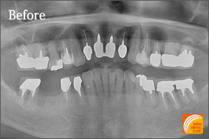 インプラント治療　症例紹介