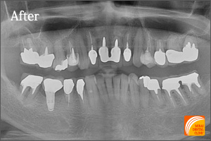 インプラント治療　症例紹介