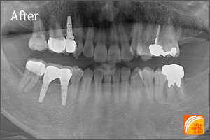 インプラント治療　症例紹介