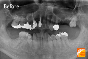 インプラント治療　症例紹介