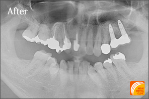 インプラント治療　症例紹介