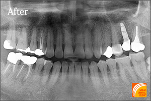 インプラント治療　症例紹介