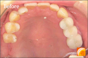 インプラント治療　症例紹介