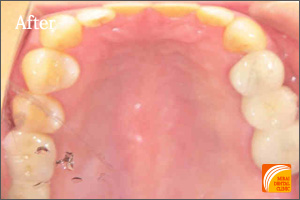 インプラント治療　症例紹介