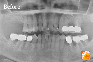 インプラント治療　症例紹介