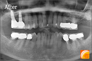 インプラント治療　症例紹介