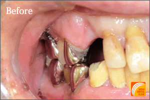 インプラント治療　症例紹介