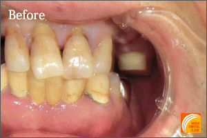 インプラント治療　症例紹介