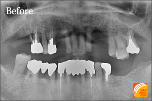 インプラント治療　症例紹介