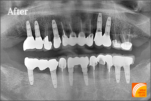 インプラント治療　症例紹介