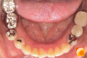 インプラント治療　症例紹介