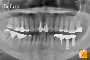 インプラント治療　症例紹介