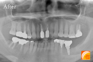 インプラント治療　症例紹介
