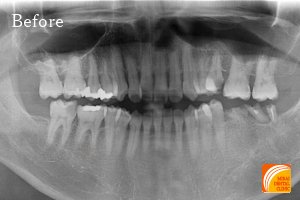 インプラント治療　症例紹介