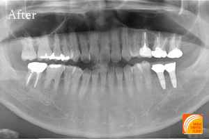 インプラント治療　症例紹介