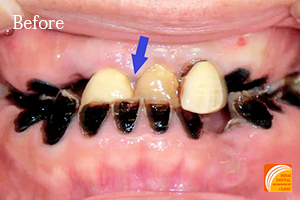 インプラント治療　症例紹介